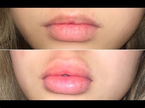 will his lip ever grow back .